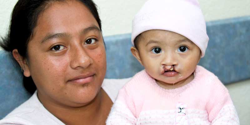 austin smiles resources - about cleft lip and palate photo