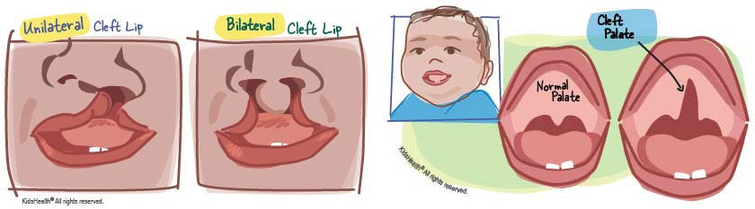 austin-smiles-about-cleft-lip-palate-illustrations