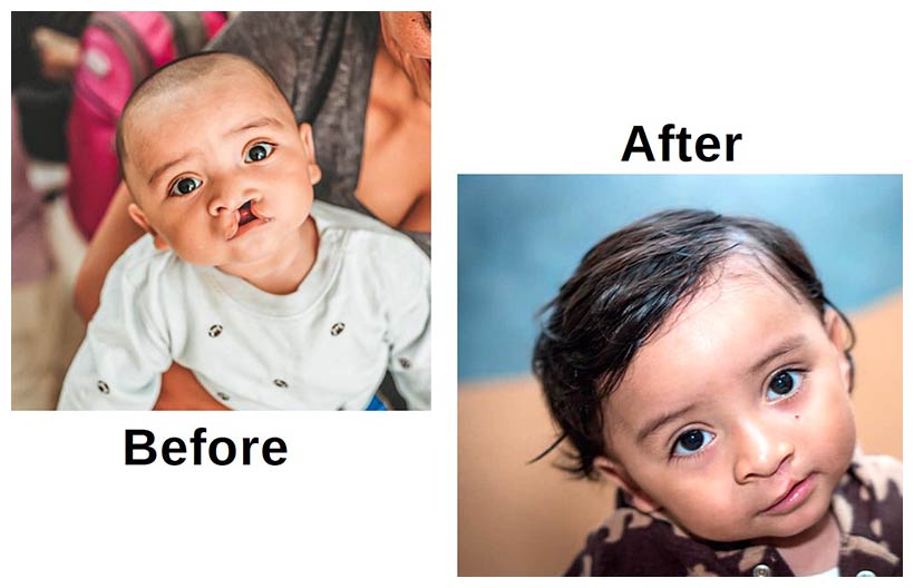 austin-smiles-event-child-before-and-after