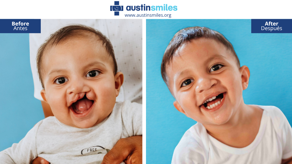 austin-smiles-event-child-before-and-after